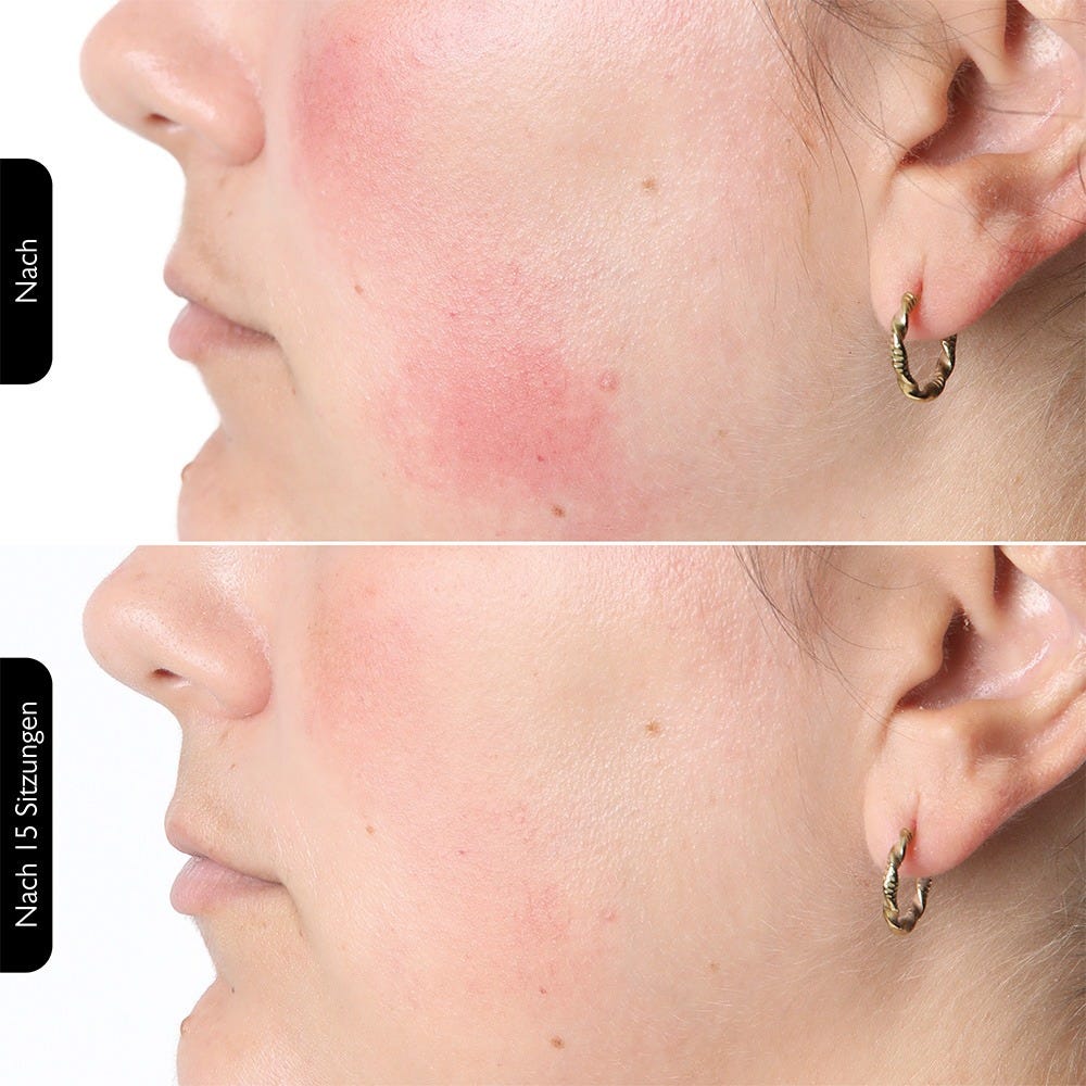 Silk'n LED Face Mask