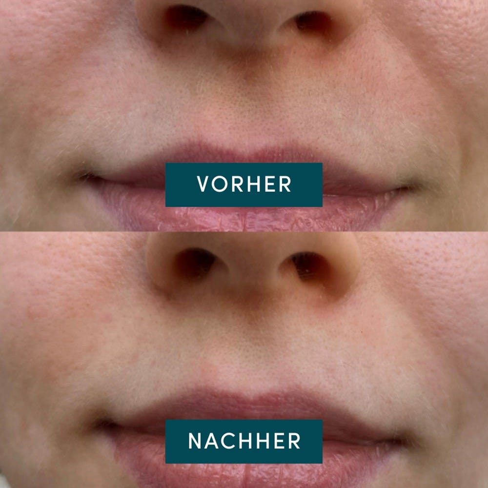 APRICOT Baumwoll-Mundpflaster mit Hyaluron 24 Stück
