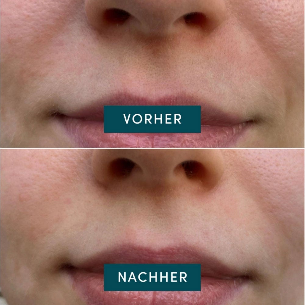 APRICOT Mini Mund Patches mit Niacinamide 24 Stück
