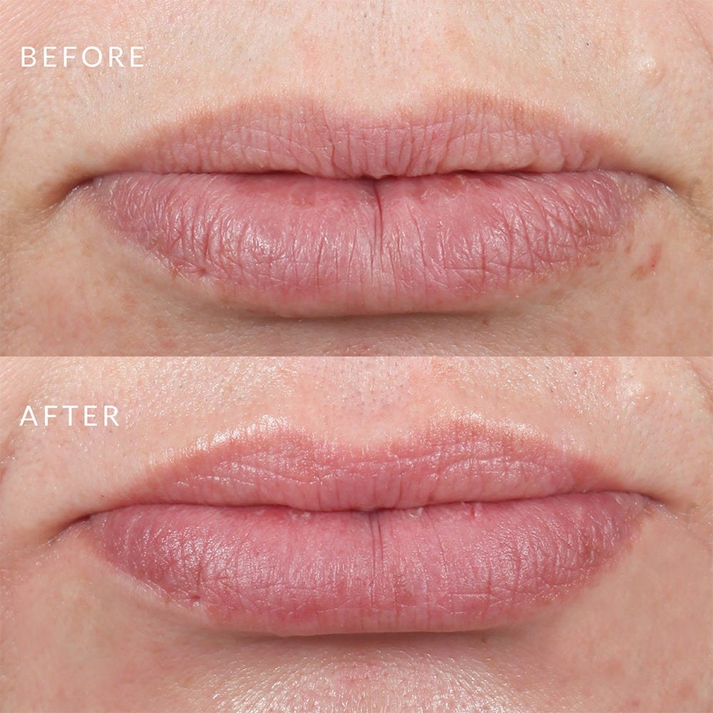 PMD Beauty Kiss Lip Plumping System