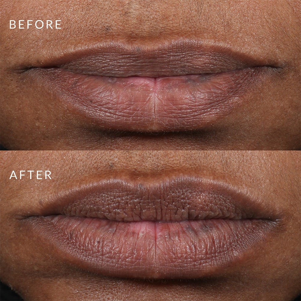 PMD Beauty Kiss Lip Plumping System