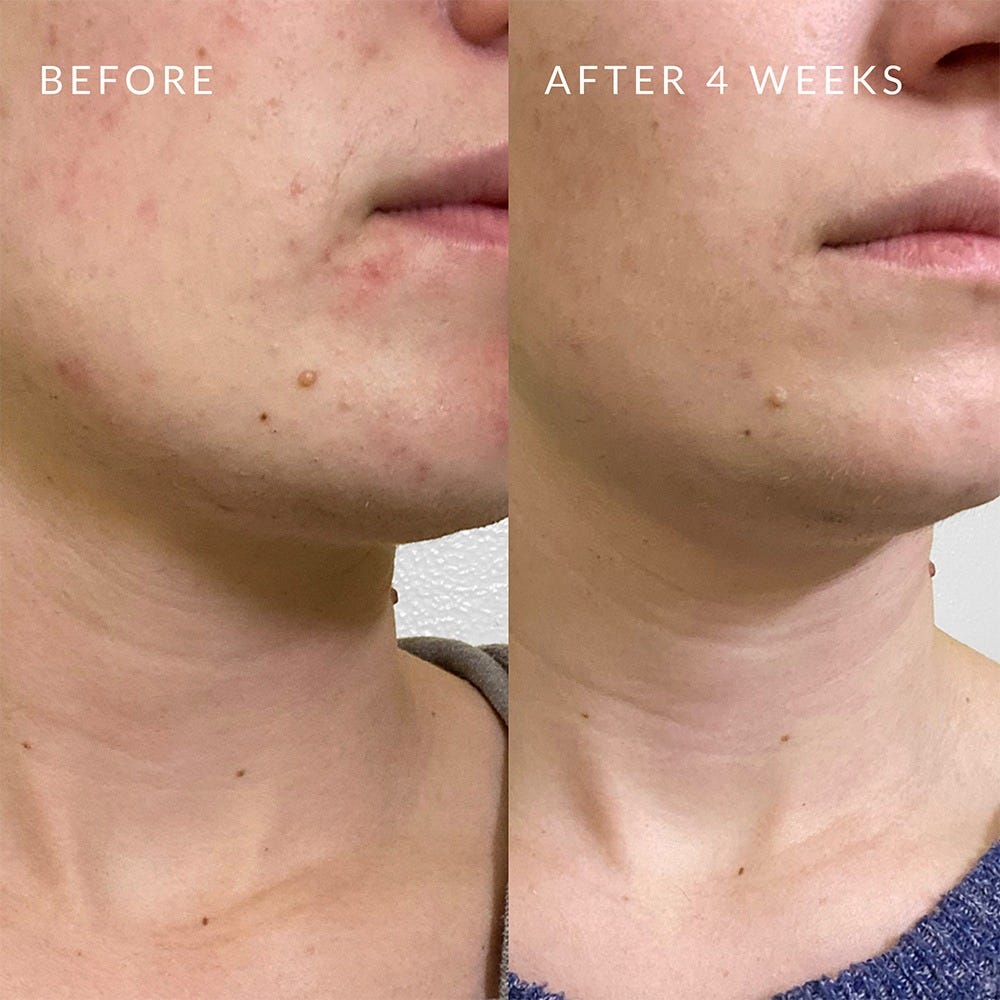 PMD Beauty Clean Acne