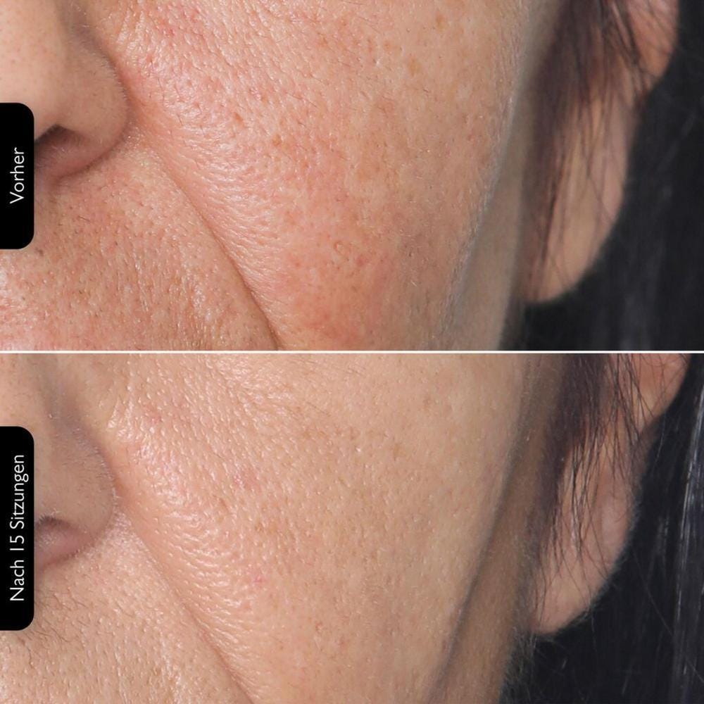 Silk'n FaceTite MultiPlatform + Serum Bundle Maximizer Kit