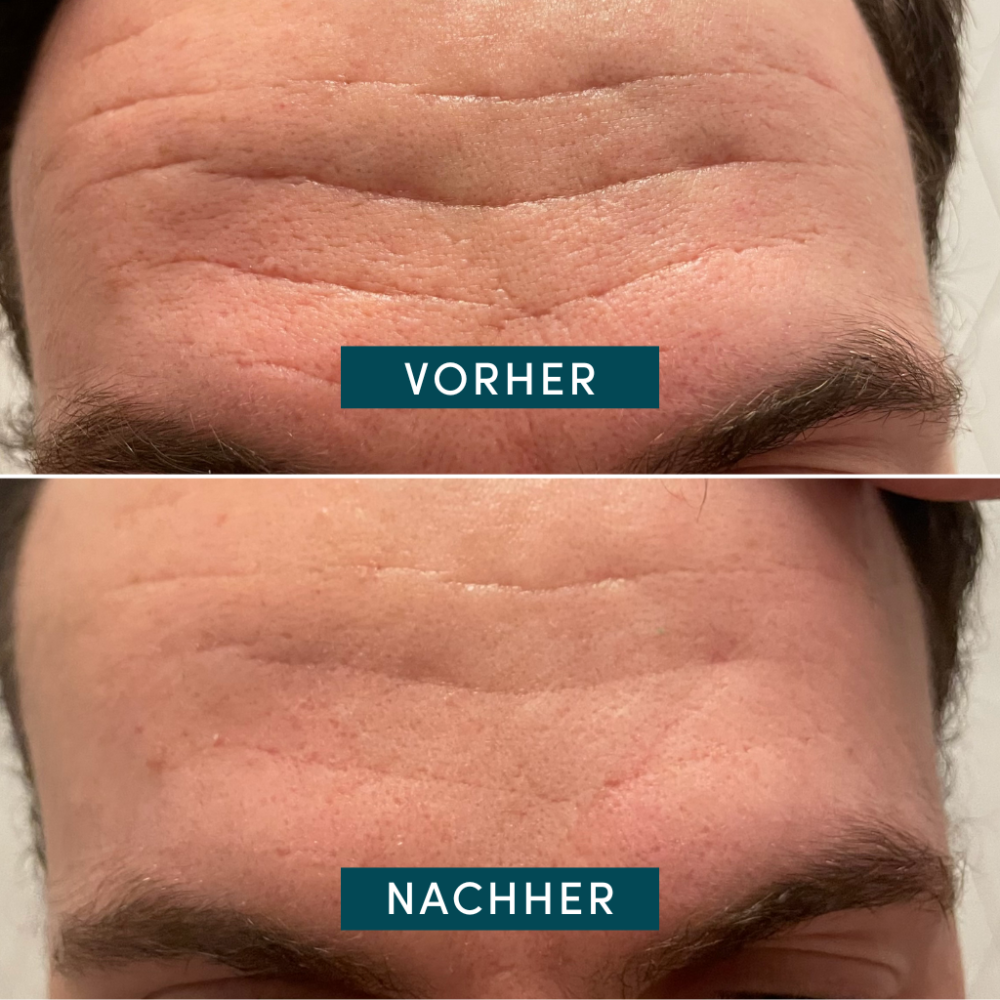 APRICOT Gesicht Patches mit Aloe Vera